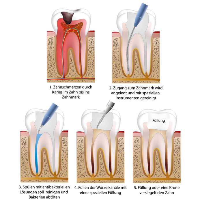 Zahnfüllungen: Informationen & Spezialisten für Zahnfüllungen